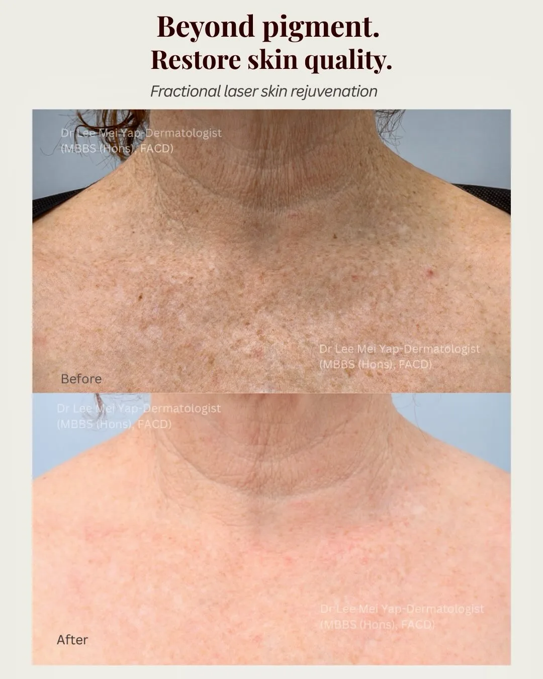 Neck  dcolletage