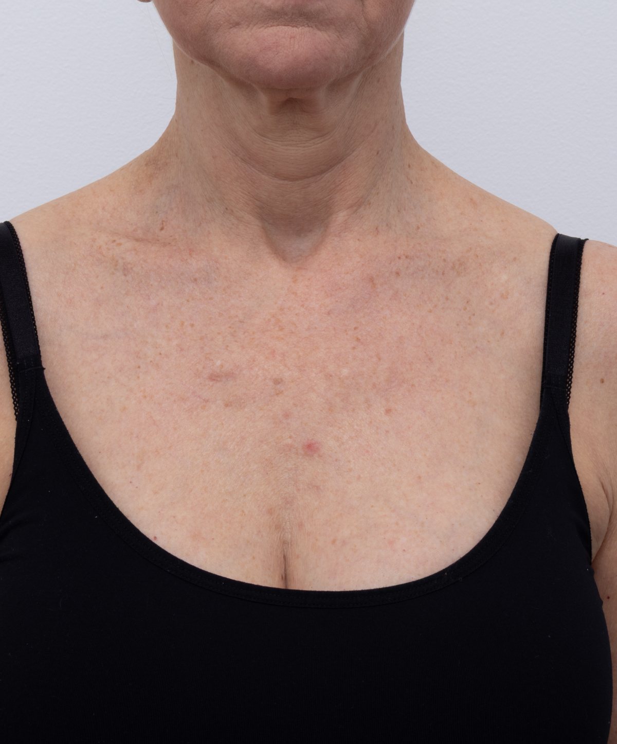 Standard colour clinical capture of the neck and décolletage